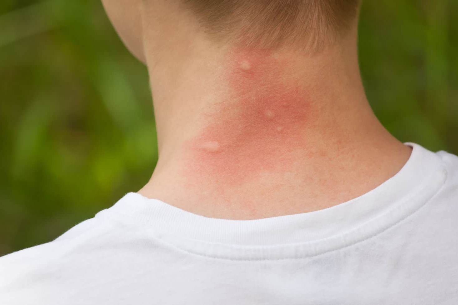 acupunctuur Houten tegen jeuk op de huid
